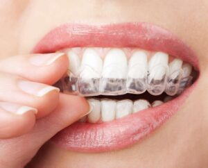 Invisalign teeth straightening