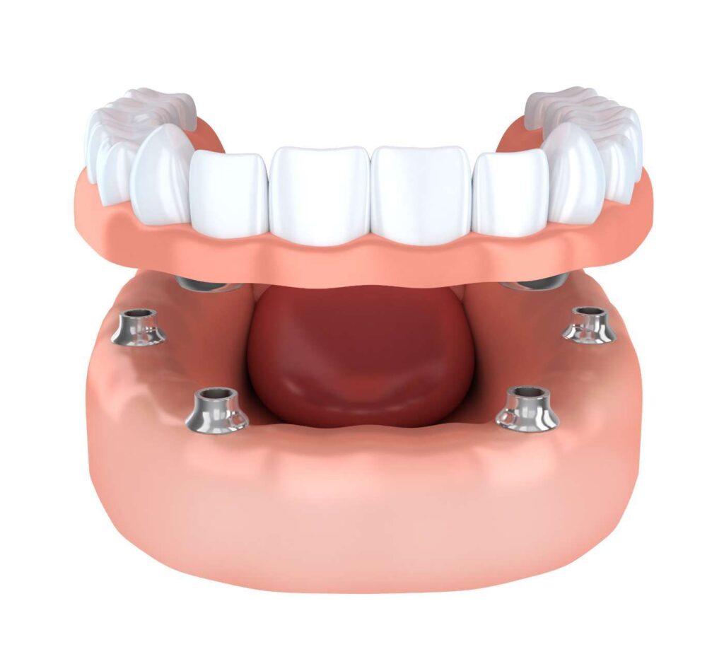 Dental implant