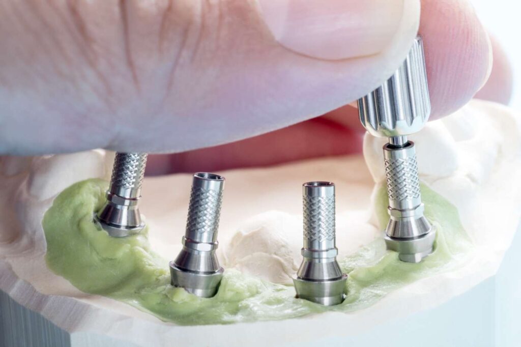 Dental implant rehabilitation