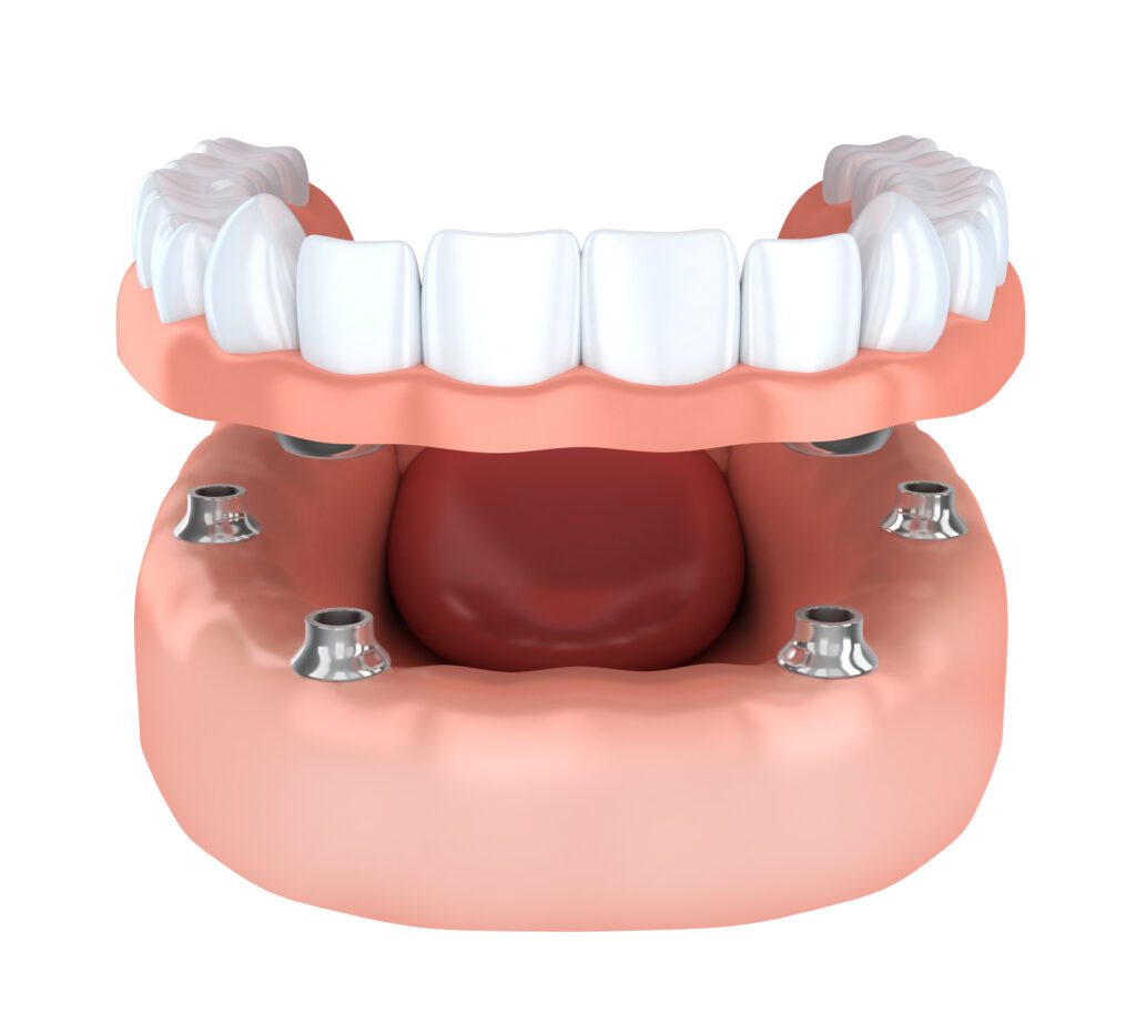 Immediate loading dental implant